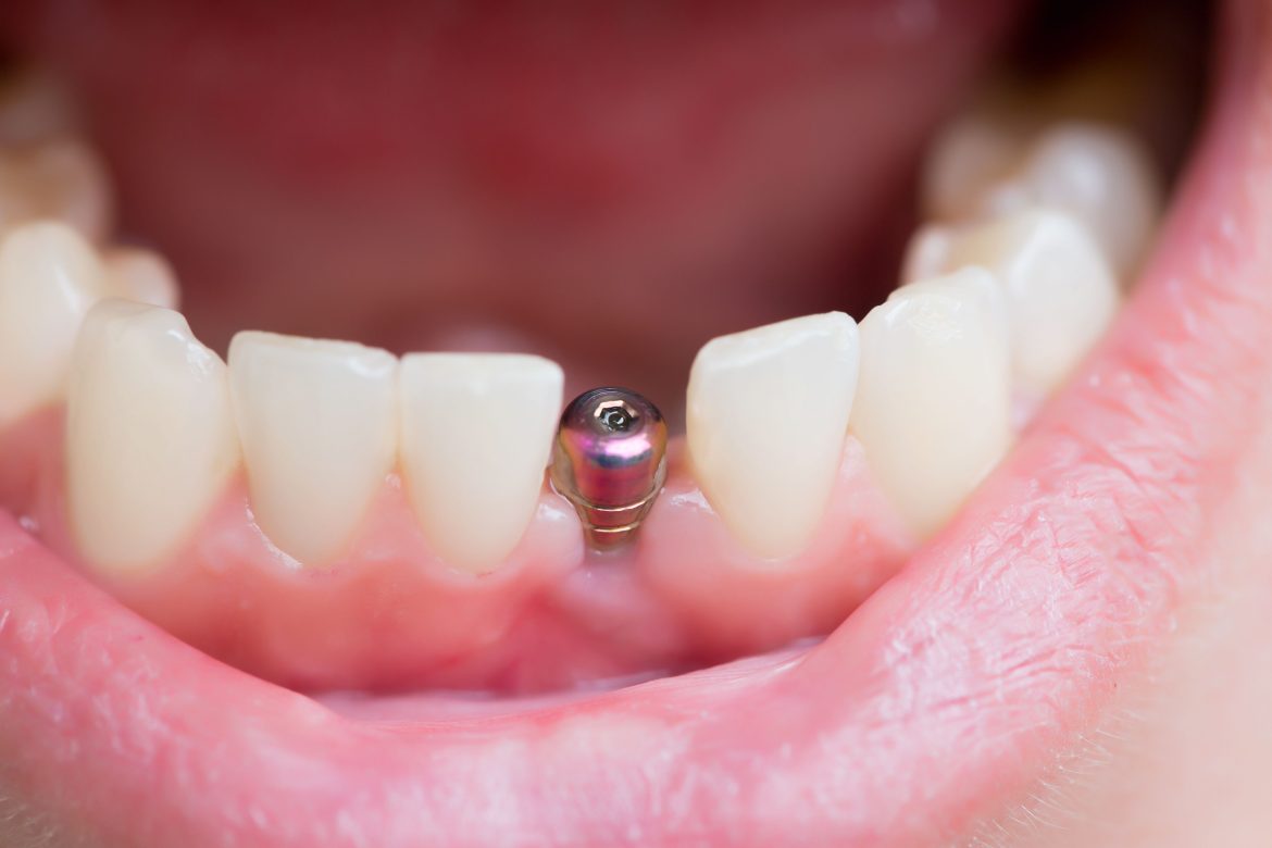 Understanding How Dental Implants Reduce the Risk of Gum Disease and Promote Healthier Oral Tissue
