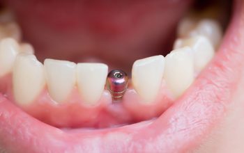 Understanding How Dental Implants Reduce the Risk of Gum Disease and Promote Healthier Oral Tissue