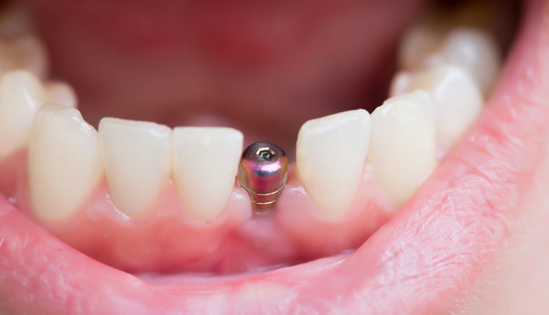 Understanding How Dental Implants Reduce the Risk of Gum Disease and Promote Healthier Oral Tissue